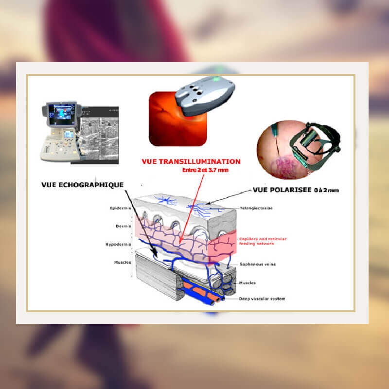 sclérose sous echographie, transillumination ou lumière polarisée