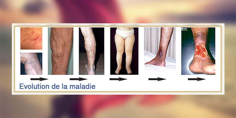 Evolution maladies véineuses